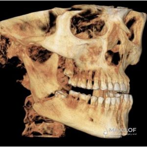 Extracción segura del tercer molar con especialista maxilofacial