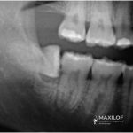 Utiliza "muela del juicio" en lugar de "tercer molar", que es un término más común. Especifica que está en el "maxilar inferior", lo cual es más preciso. Menciona que es una "radiografía dental", lo que es más típico en estos casos que una ilustración 3D. Incluye la frase "extracción quirúrgica", que enfatiza la naturaleza del procedimiento. Usa "especialista maxilofacial", que es otra forma de referirse al cirujano maxilofacial. Es descriptivo y conciso, ideal para un texto alternativo. Incorpora palabras clave relevantes para el SEO sin sobrecargar el texto. Proporciona contexto suficiente para quienes no puedan ver la imagen.