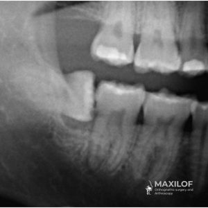 Utiliza "muela del juicio" en lugar de "tercer molar", que es un término más común. Especifica que está en el "maxilar inferior", lo cual es más preciso. Menciona que es una "radiografía dental", lo que es más típico en estos casos que una ilustración 3D. Incluye la frase "extracción quirúrgica", que enfatiza la naturaleza del procedimiento. Usa "especialista maxilofacial", que es otra forma de referirse al cirujano maxilofacial. Es descriptivo y conciso, ideal para un texto alternativo. Incorpora palabras clave relevantes para el SEO sin sobrecargar el texto. Proporciona contexto suficiente para quienes no puedan ver la imagen.