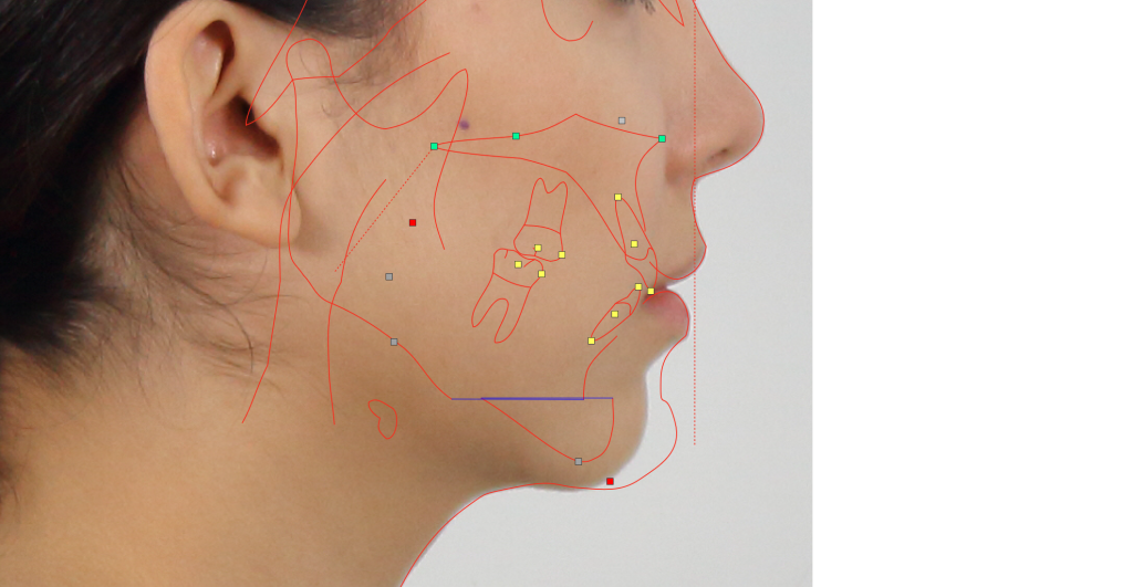 Antes y después de mentoplastia ósea: perfil facial mejorado y mentón redefinido